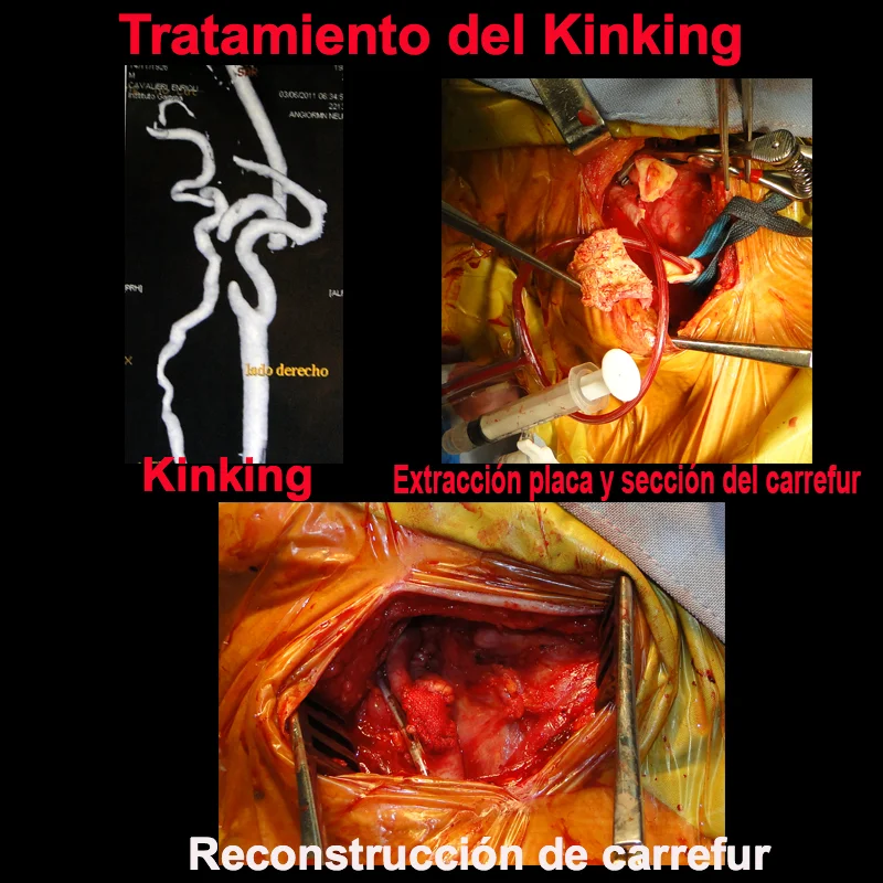 RECONSTRUCCIÓN CAROTÍDEA