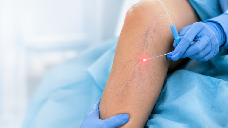 Tratamiento de Várices con Cirugía Laser