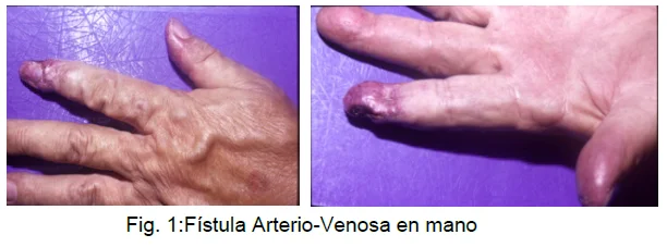 FISTULAS ARTERIO – VENOSAS EN MIEMBRO INFERIOR