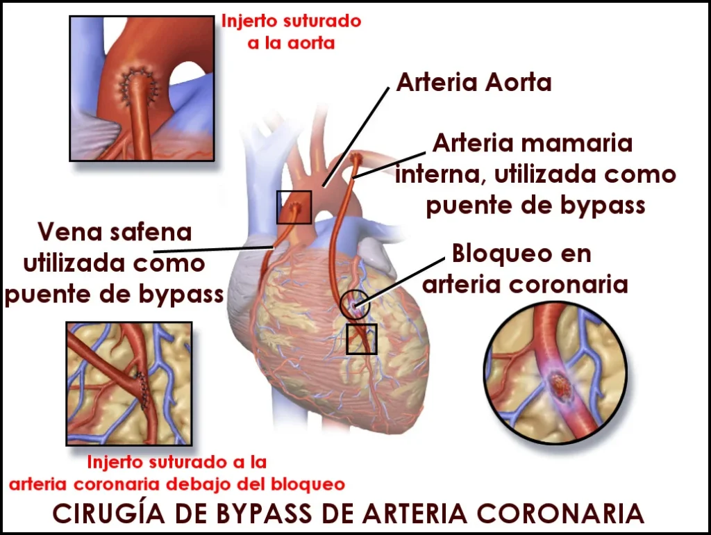 Cirugía Coronaria Sin Circulación Extracorpórea