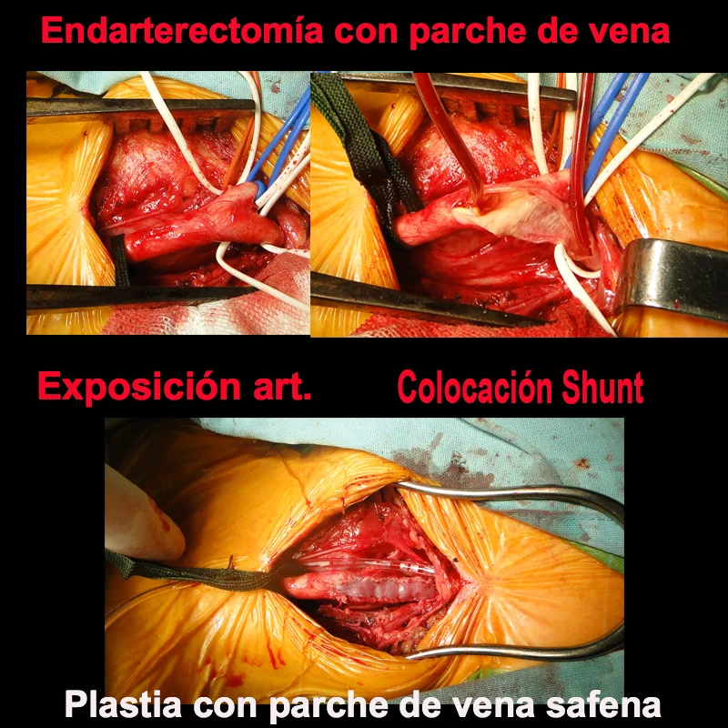 ENDARTERECTOMÍA CAROTÍDEA