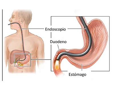 PERFORACIÓN ESOFÁGICA